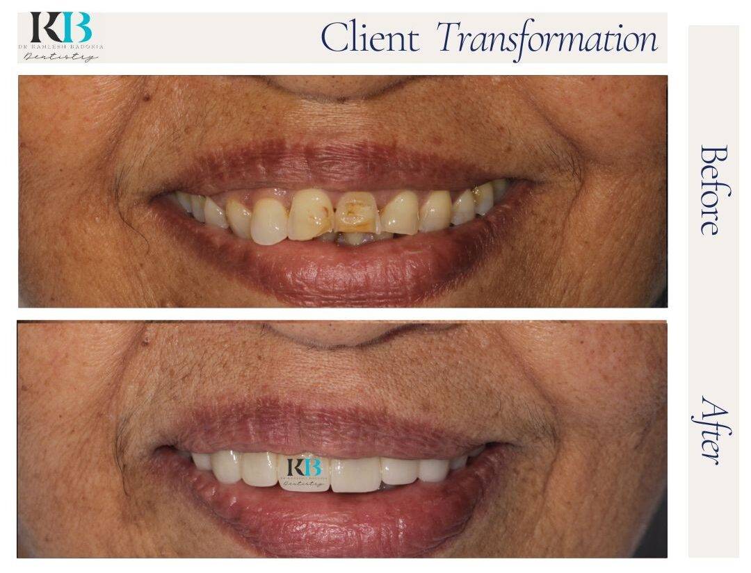 Before and After Instagram Post - 1 Before and After Instagram Post - 1