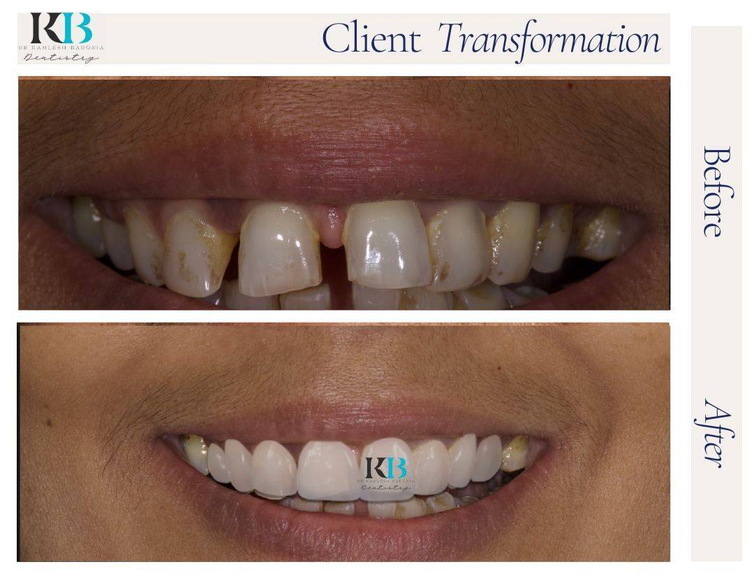 Before and After Instagram Post - 1 Before and After Instagram Post - 1