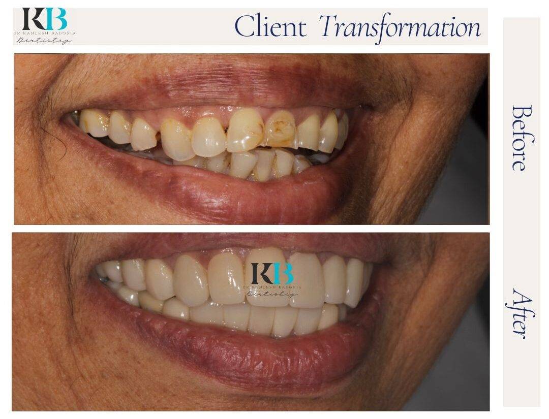 Before and After Instagram Post - 1 Before and After Instagram Post - 1