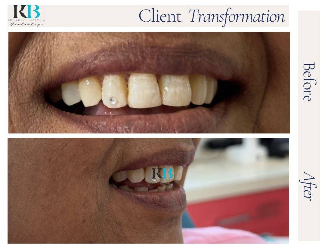 Before and After Instagram Post - 1 Before and After Instagram Post - 1