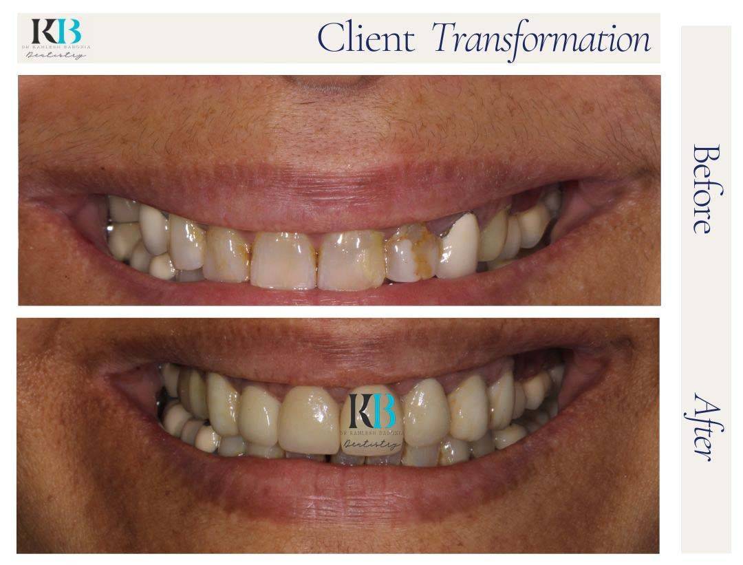 Before and After Instagram Post (5) Before and After Instagram Post (5)