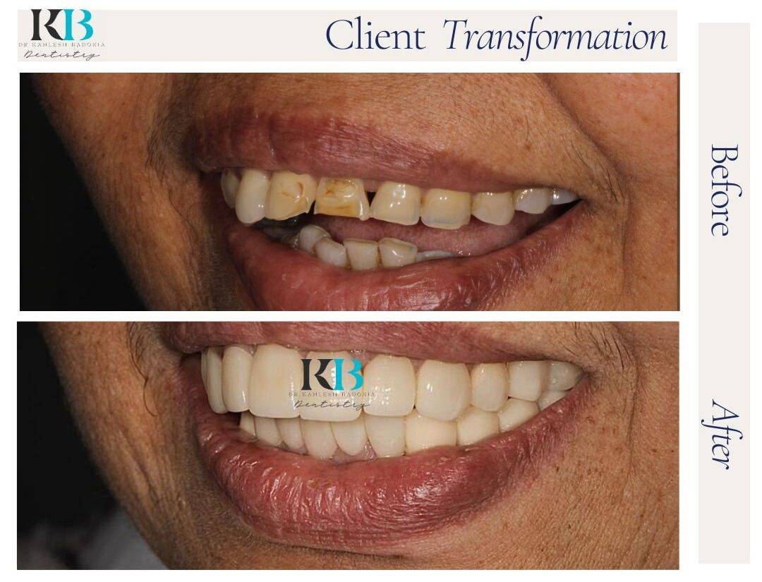 Before and After Instagram Post - 1 Before and After Instagram Post - 1